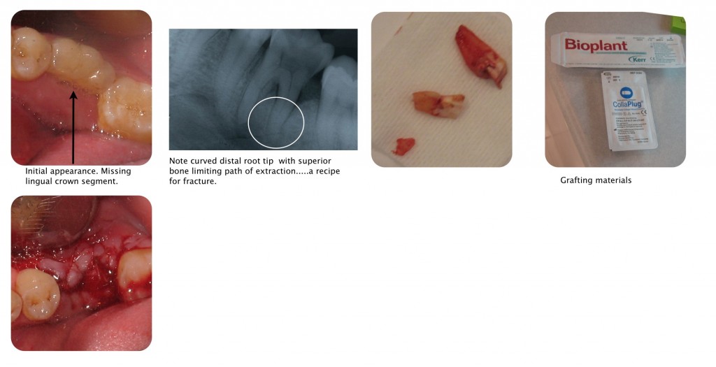 Extraction with root tip Fracture